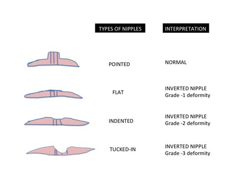 newly inverted nipple|Common Causes and Treatment for Inverted Nipples